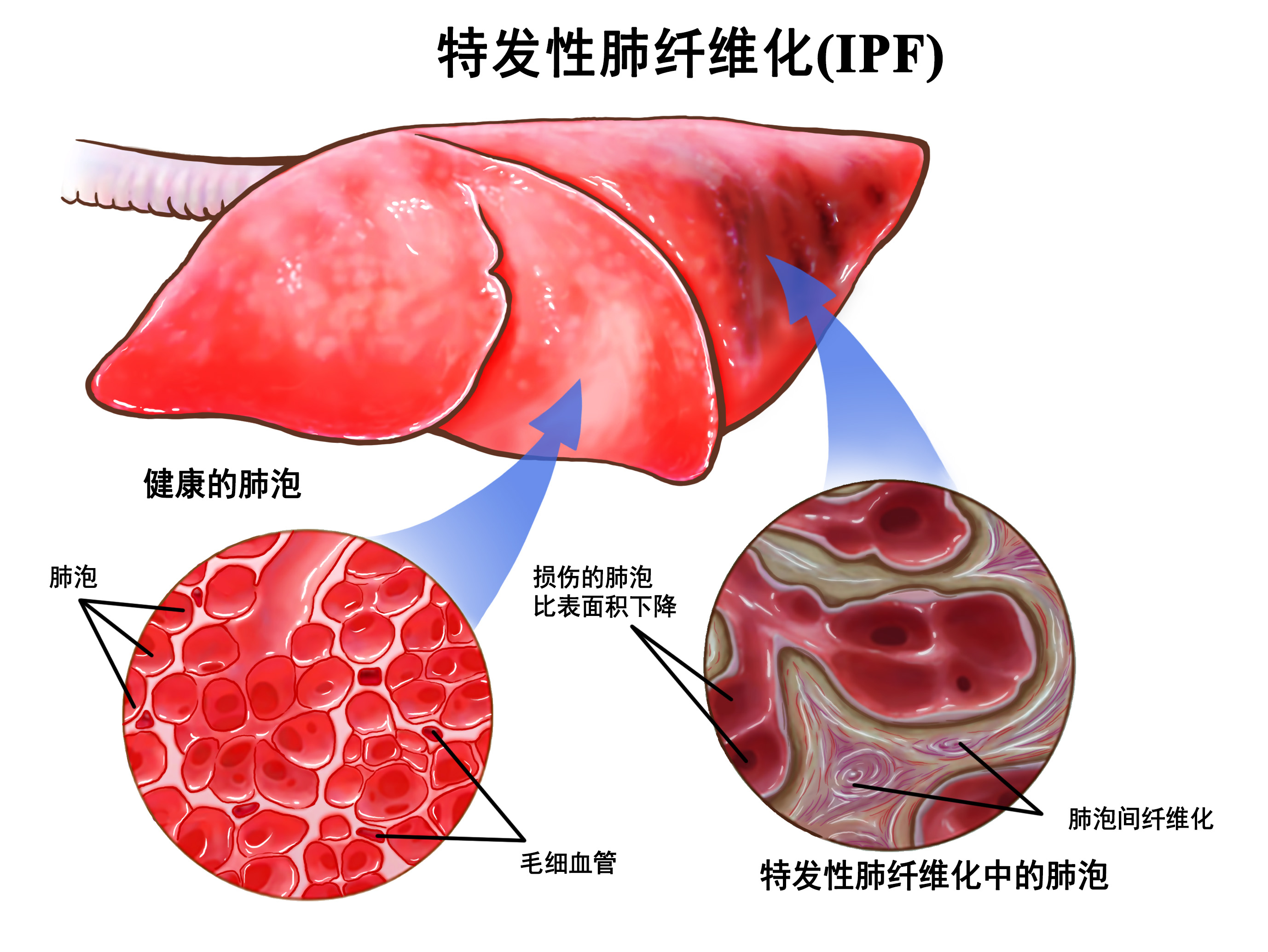 特发性肺纤维化（IPF）
